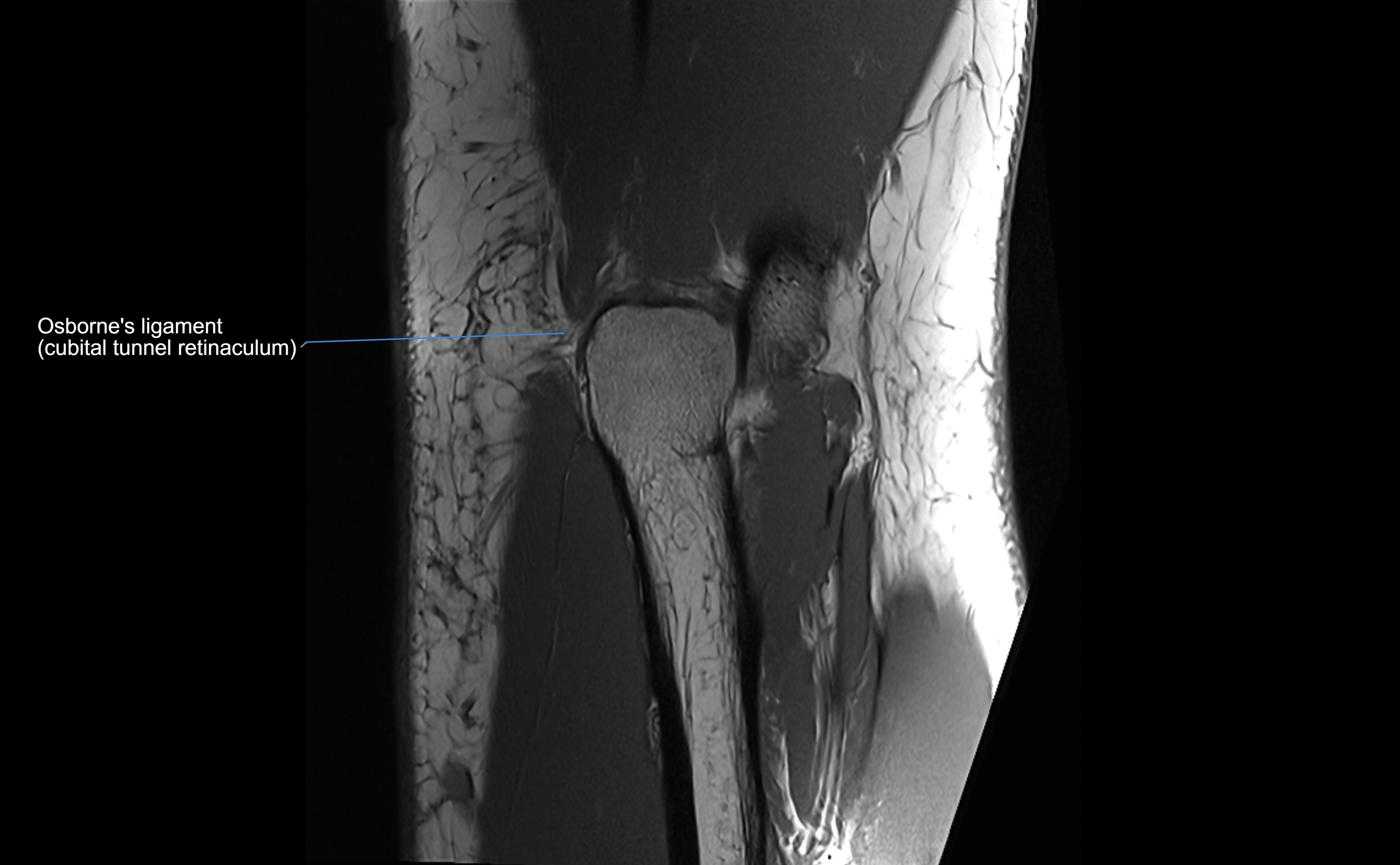 MRI elbow ligaments coronal cross sectional anatomy 3T  radiology  image-img-07001-00026.webp